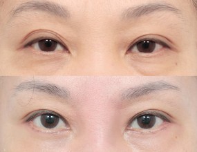 after & before 4